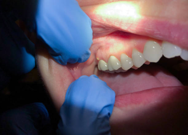 Best Emergency Treatment for Toothache in Bee Cave, TX